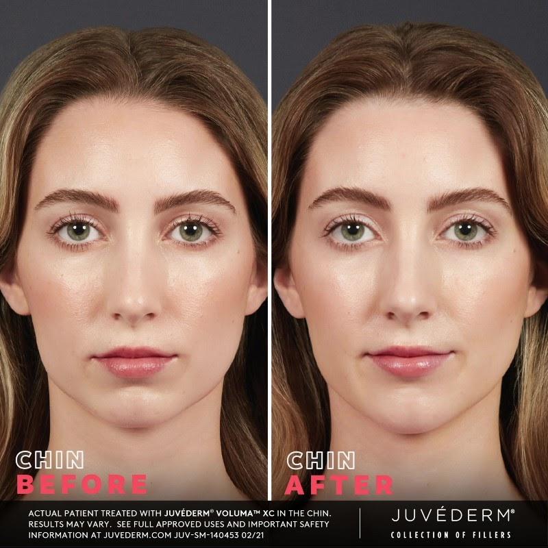 JUVEDERM for Fillers