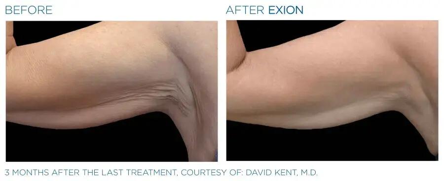 Before & After | EXION Body | Be Natural Aesthetics | Innovative Endodontics