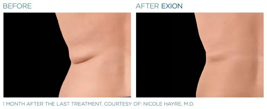 Before & After | EXION Body | Be Natural Aesthetics | Innovative Endodontics