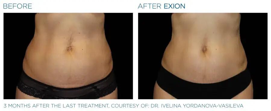 Before & After | EXION Body | Be Natural Aesthetics | Innovative Endodontics