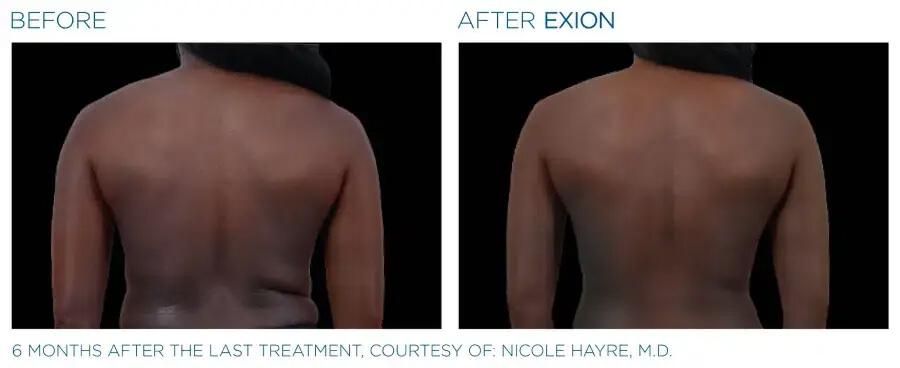 Before & After | EXION Body | Be Natural Aesthetics | Innovative Endodontics