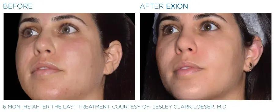 Before & After | EXION Face | Be Natural Aesthetics | Innovative Endodontics