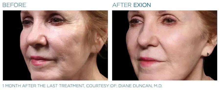 Before & After | EXION Face | Be Natural Aesthetics | Innovative Endodontics
