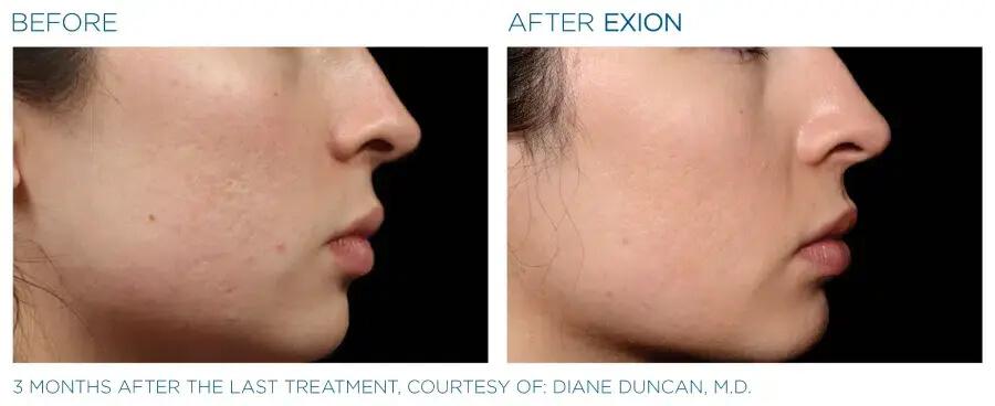 Before & After | EXION RF Microneedling | Be Natural Aesthetics | Innovative Endodontics