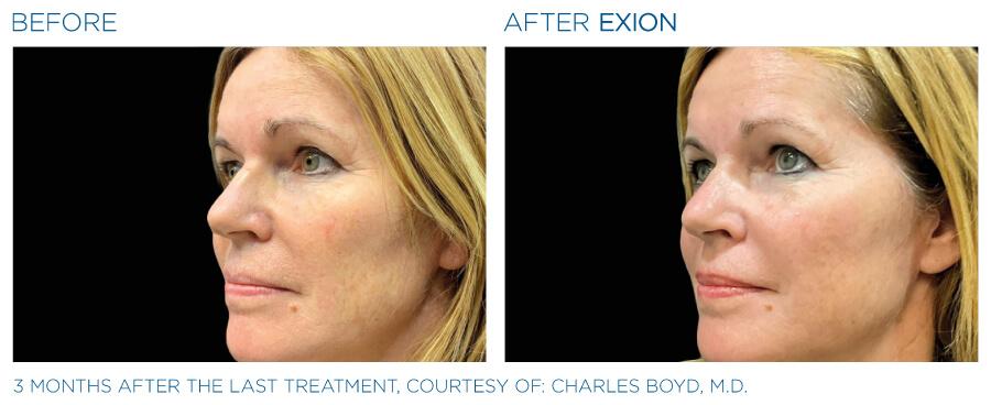 Before & After | EXION RF Microneedling | Be Natural Aesthetics | Innovative Endodontics